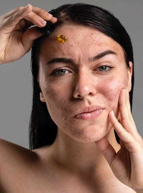 Acne – mulher a aplicar tratamento facial em pele com acne.
